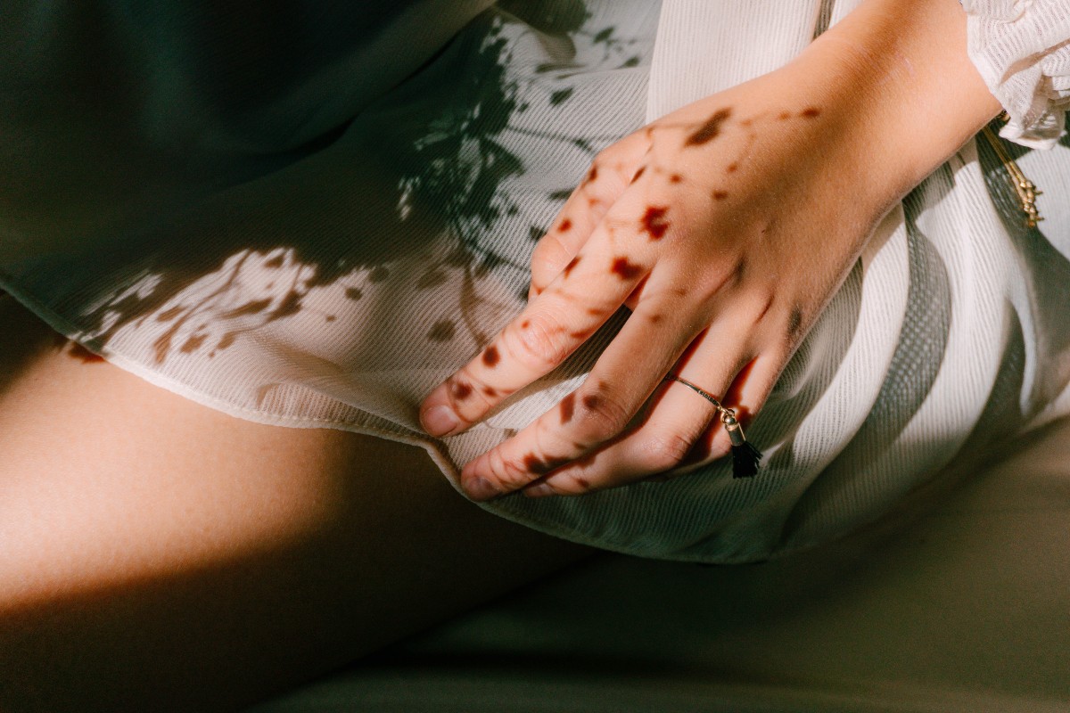 Asiatic Acid for Skin
