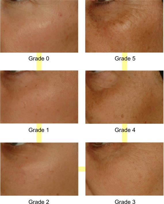 Effect of sun exposure on aging signs