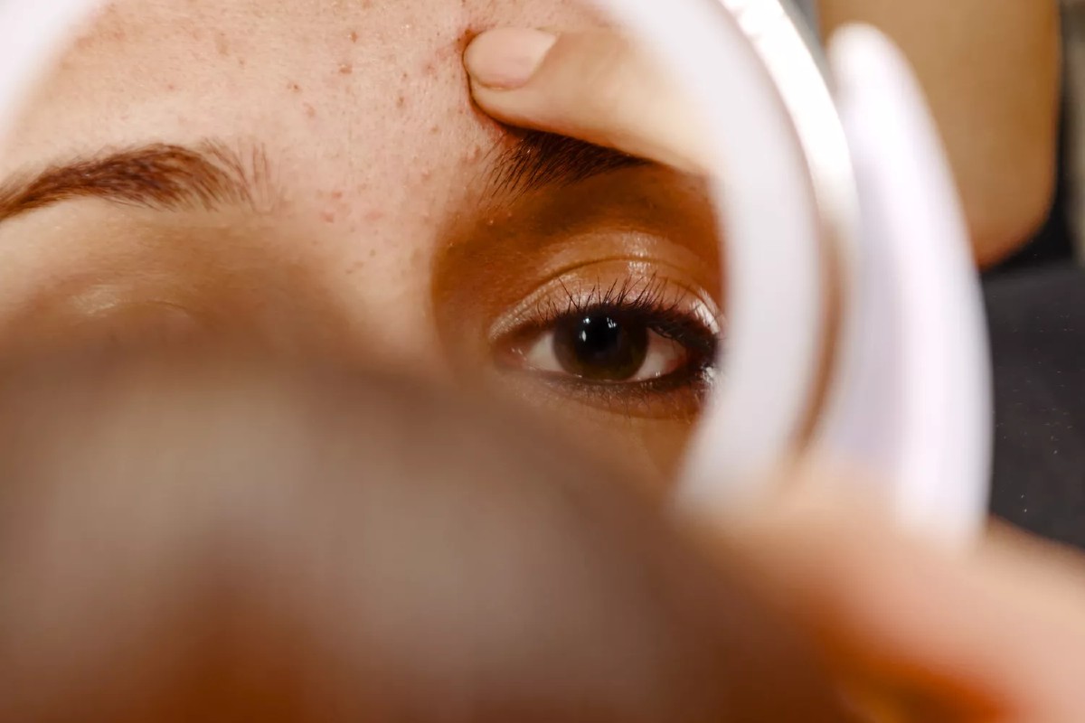 sudden acne breakouts causes
